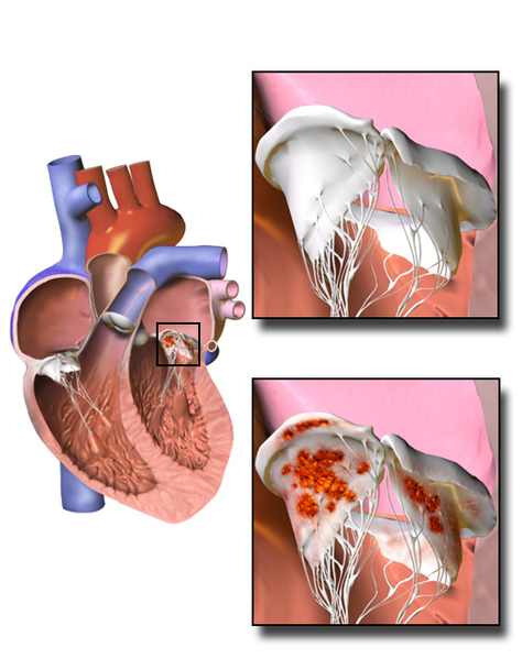 Illustration showing Infective Endocarditis closeup boxes