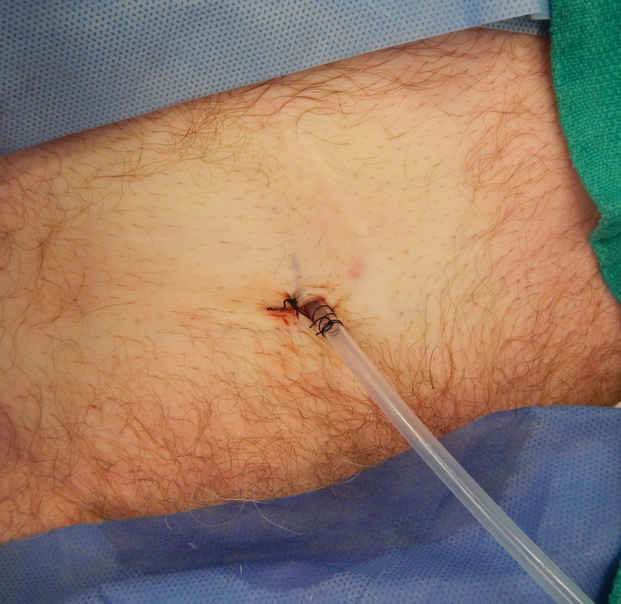 Photo showing a newly placed suprapubic catheter