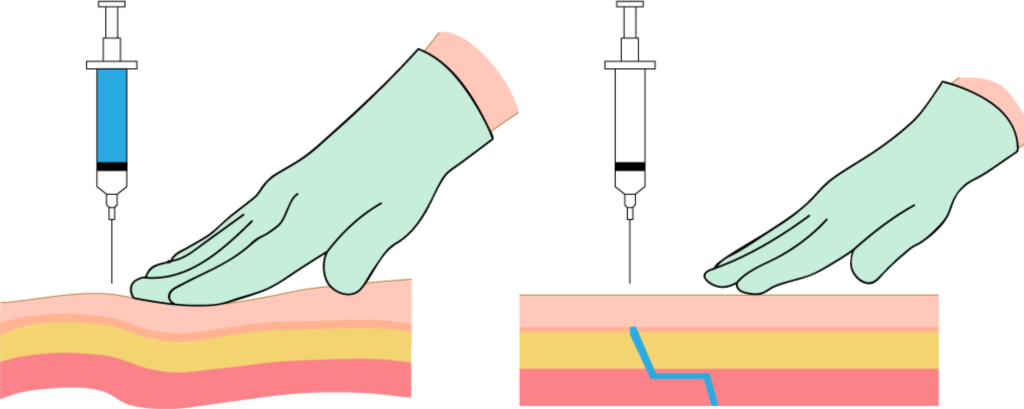 Illustration showing two parts of the Z track method