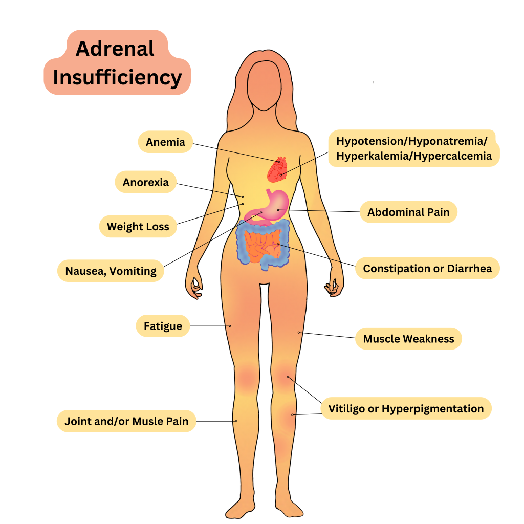 Infographic showing Clinical Manifestations of Adrenal Insufficiency in a female form with text labels for symptoms