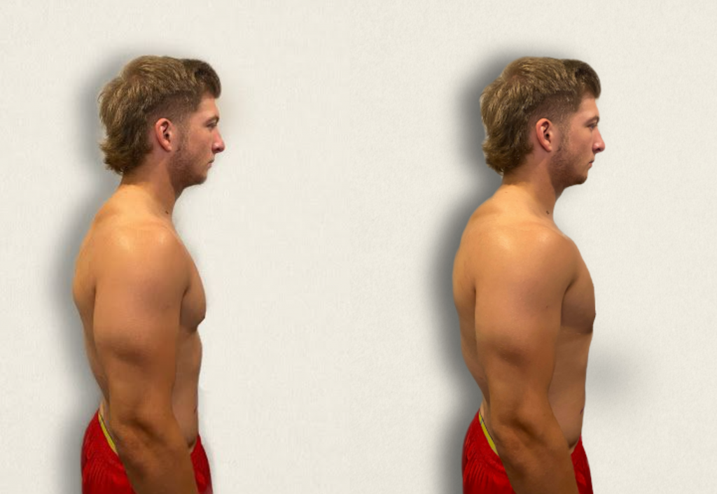 Image of a simulated patient showing Increased Anterior-Posterior (A-P) Diameter of the Chest compared to normal chest A-P diameter on the right.