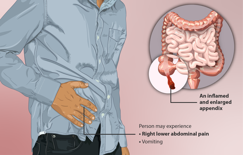 Illustration showing a personal with hand over area of appendix, indicating pain from appendicitis. A small inset shows an internal closeup of the inflamed and enlarged appendix.