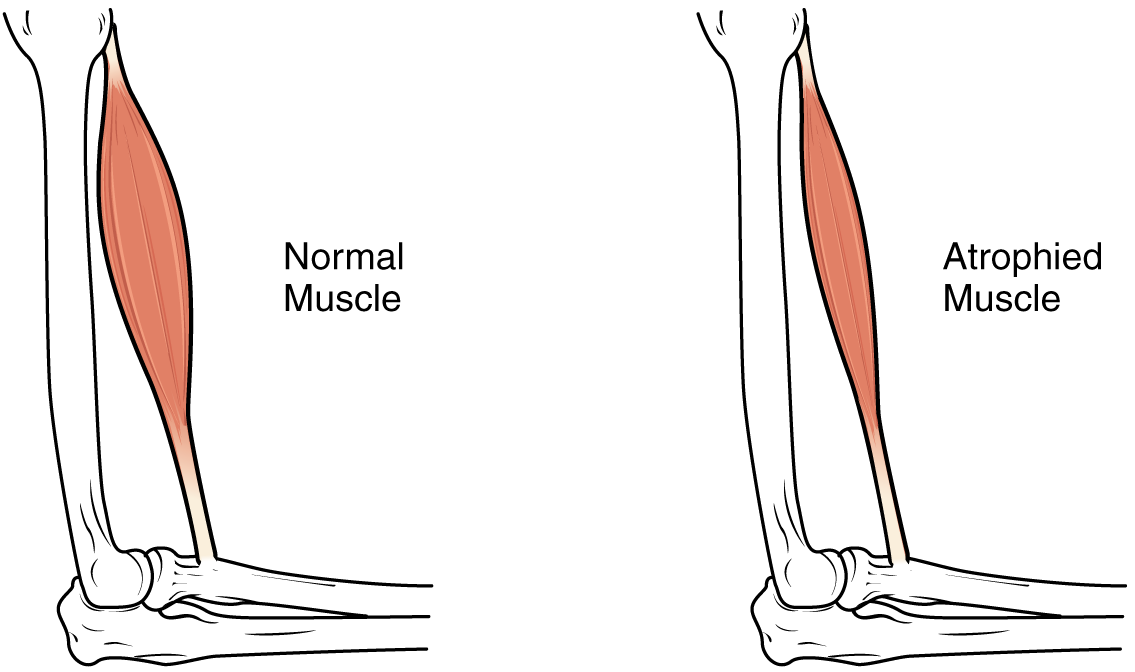 Illustration showing a normal and an atrophied muscle