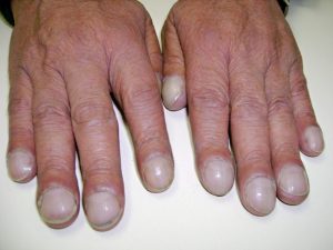 Photo showing Clubbing of Fingertips