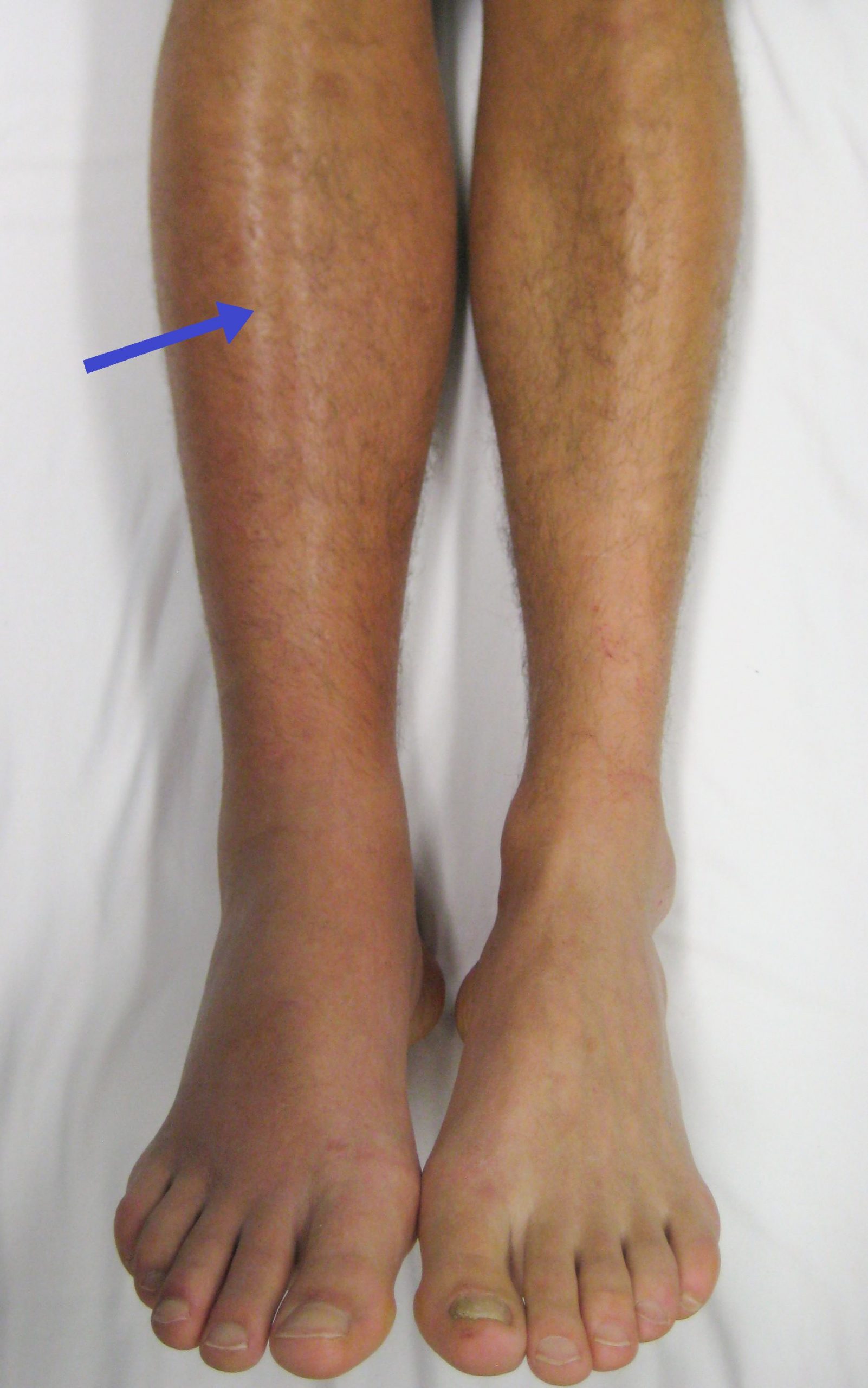 “Deep_vein_thrombosis_of_the_right_leg.jpg” by James Heilman, MD is licensed under CC BY-SA 3.0 Image showing Deep Vein Thrombosis (DVT) with an arrow pointing to leg affected