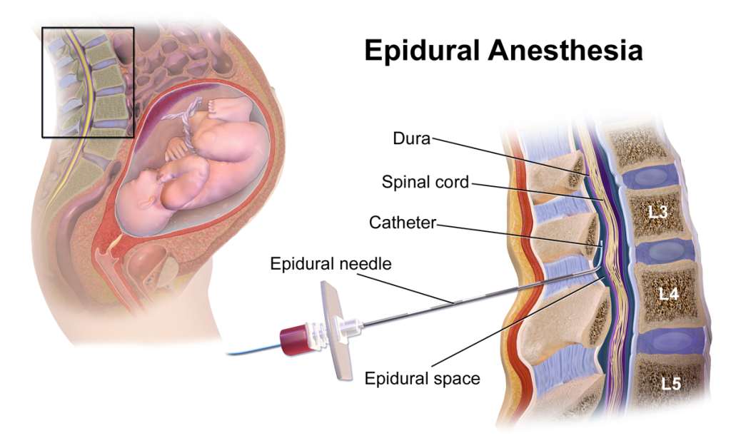 Illustration of epidural anesthesia