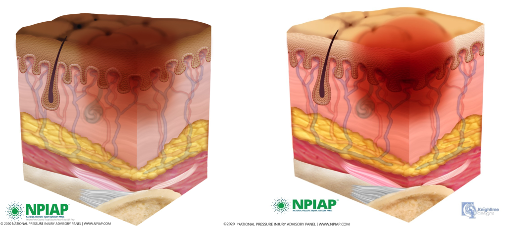 Image showing stage 1 pressure injury on both dark and light pigmented skin