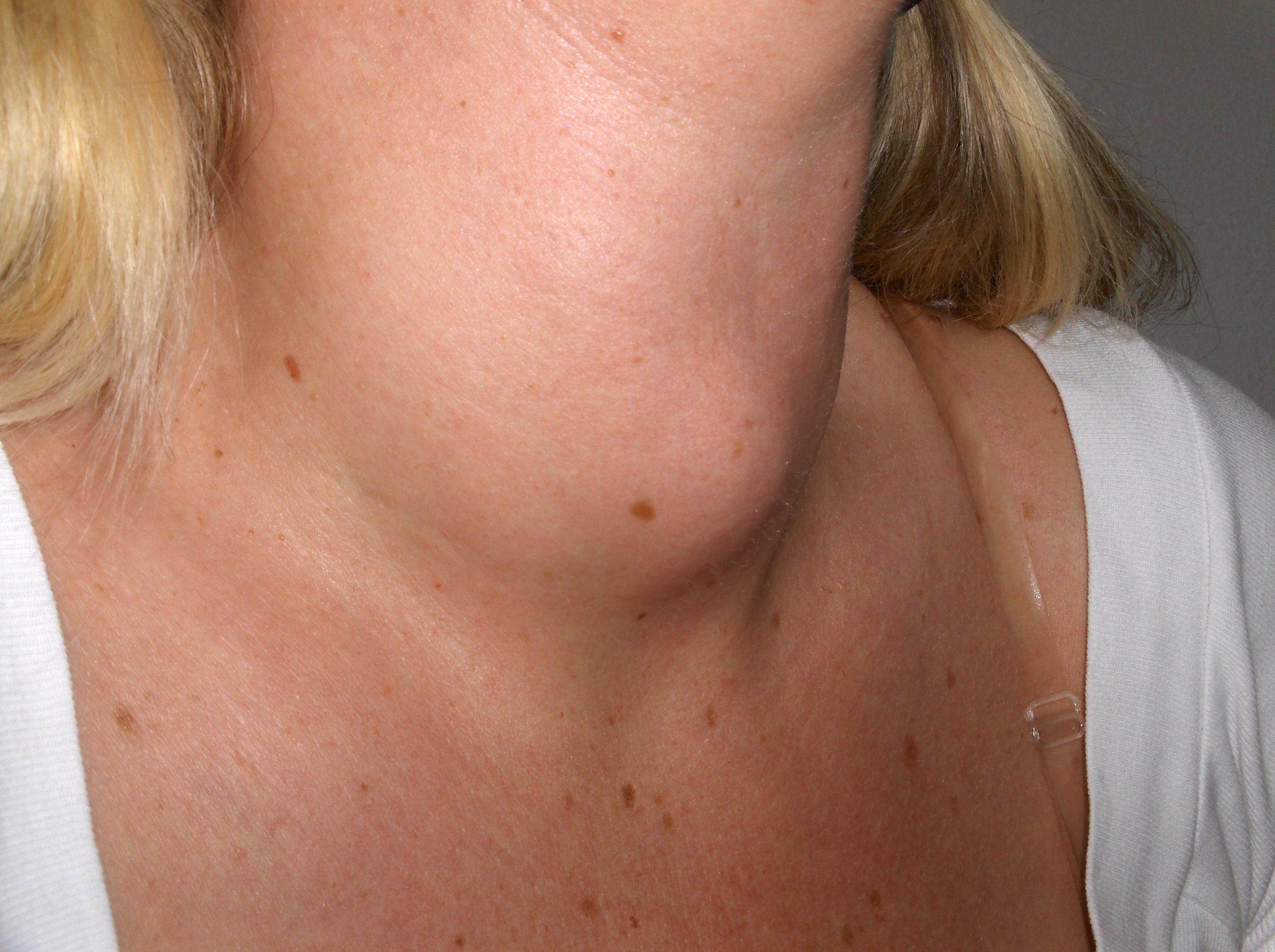 Photo showing a goiter on a person's neck