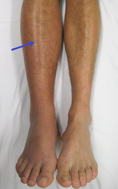 Photo showing deep vein thrombosis