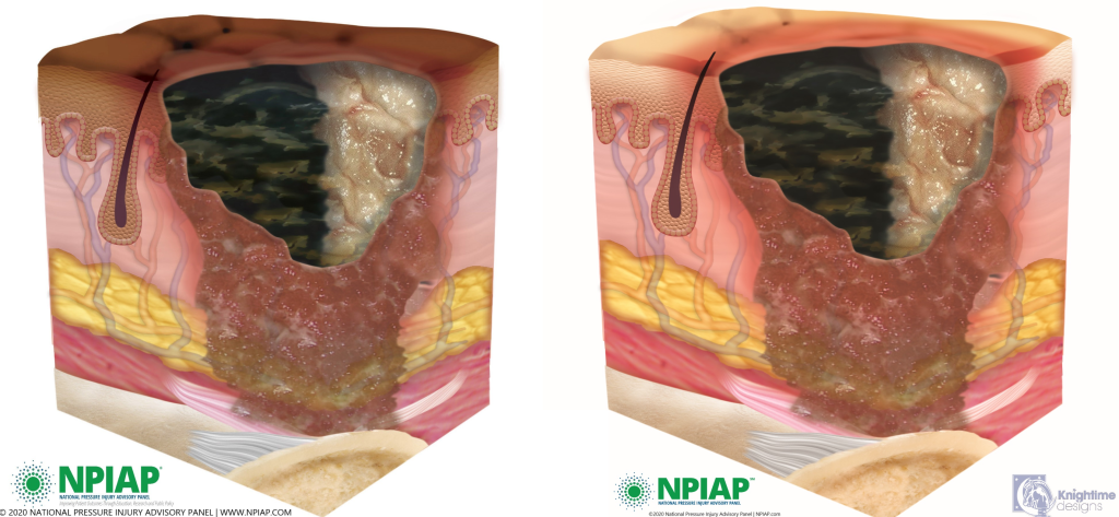 Image showing unstageable pressure injury on both dark and lightly pigmented skin