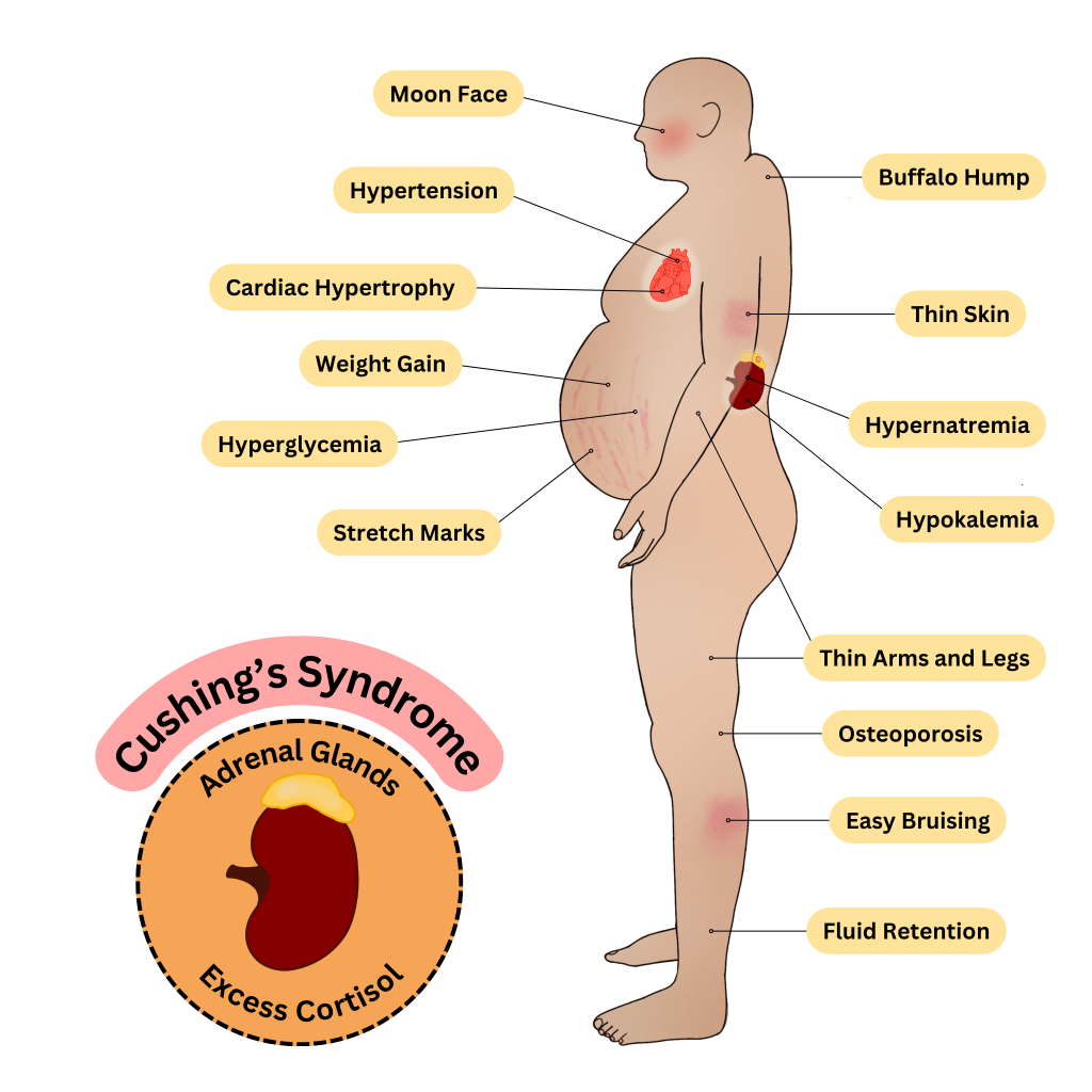 Infographic showing Common Manifestations of Cushing's Disease and Cushing's Syndrome