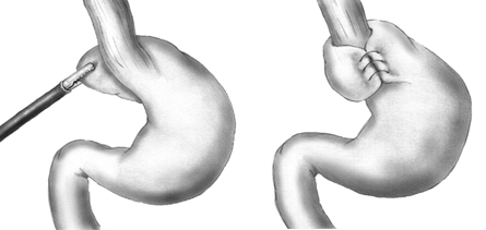 Illustration showing the Nissen Fundoplication Procedure