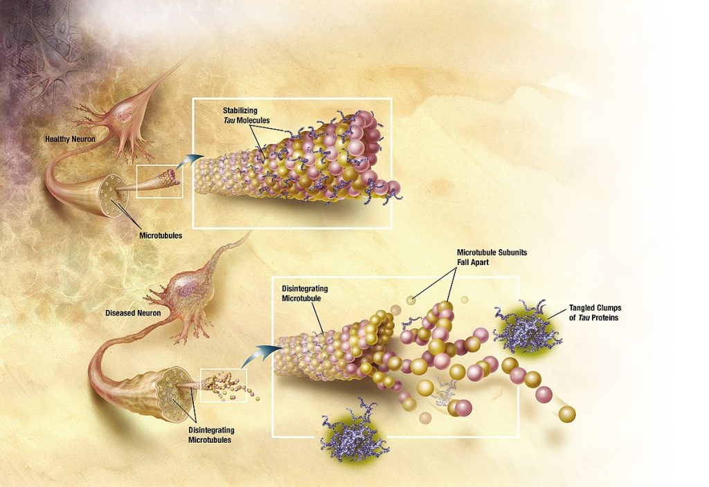 Illustration showing Abnormal Proteins Causing Neurodegeneration in a diseased neuron